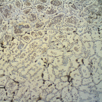 Micrography of the transverse section of the TUBE REMOVED FROM SERVICE, in the center of the thickness, showing the austenitic structure with primary carbides network and secondary precipitation.