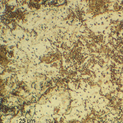 The micrography of the 13Cr SS in the transverse section, at the collapsed region, shows a ferritic matrix structure (overtempered) with the previous austenite grain boundaries decorated by phases (carbides and probably martensite islands), indicating that the material was exposed to a high tempering temperature that created a partial austenitizing condition. It explains the material low toughness and lower strenght (than required).