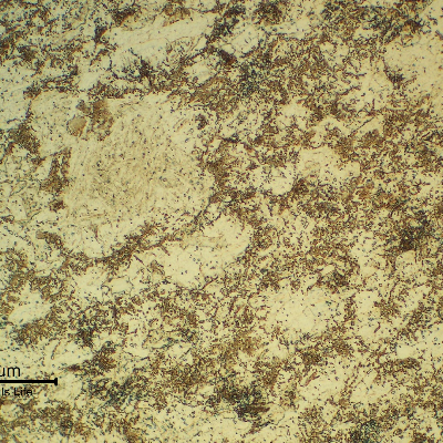 13Cr SS transverse section micrography, at the collapsed region, showing a ferritic matrix structure (overtempered) with the previous austenite grain boundaries decorated by phases (carbides and probably martensite islands), indicating that the material was exposed to a high tempering temperature that created a partial austenitizing condition. It explains the material low toughness and lower strenght (than required).
