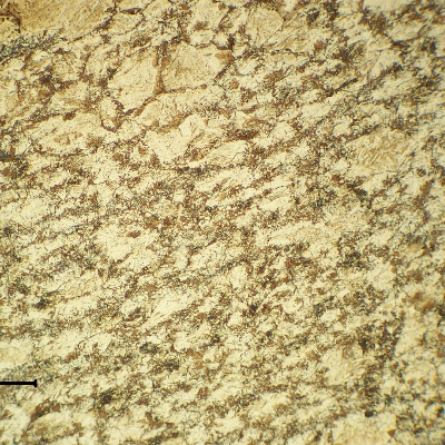 13Cr SS in the transverse section, at the collapsed region, showing a non uniform structure that evidences an usuitable heat treatment during fabrication, and explains the material low strenght.