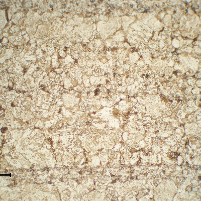 13Cr SS longitudinal section micrography, at the collapsed region, showing a ferritic matrix structure (overtempered) with the previous austenite grain boundaries decorated by phases (carbides and probably martensite islands), indicating that the material was exposed to a high tempering temperature that created a partial austenitizing condition. It explains the material low toughness and lower strenght (than required).