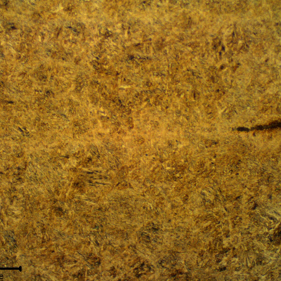 Micrographic aspect of the disc in the longitudinal section. Tempered martensitic structure, probably strain hardened.