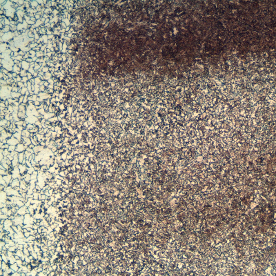 Micrography of the tubular 4130 forging at the heat affected zone (HAZ), butt weld root. The structure is ferritic bainitic because of the multiple reheatings in high temperature.