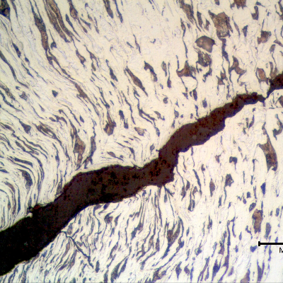 Micrographic detail of a longitudinal section of the bolt at the bottom of the thread fillet adjacent to the fracture, presenting a ductile cracking propagating with a plastic deformation. 
The deformation lines of the cold formed process are also deformed by the cracking propagation and there are some other small secondary cracks at 90° from the principal cracking.