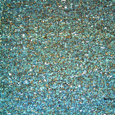 Micrography of an axial section of the roller bearing, at the internal surface, where the hardness level was about 21 HRc, indicating that in this region the material was not properly quenched and tempered.