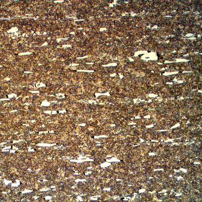 Micrographic detail of the roller bearing microstructure, close to the external surface, presenting 64 HRc and a microstructure that is martensitic with large carbides.