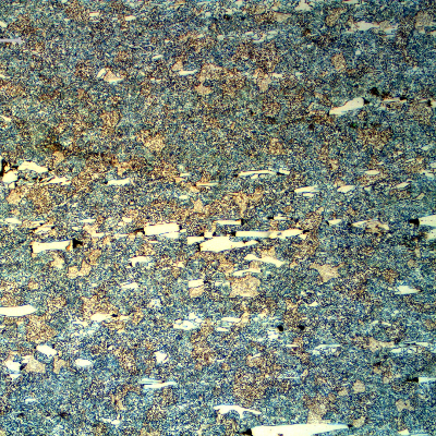 Micrographic detail of the roller bearing microstructure, close to the internal surface, presenting 21 HRc that reveals that the matrix is not martensitic. It is ferritic with large aligned carbides (cracked).