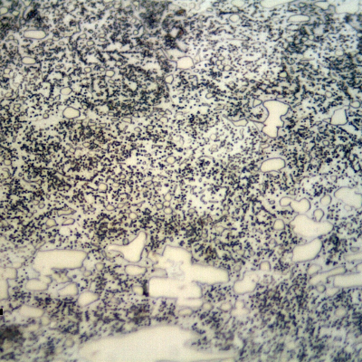 Ferritic structure close to the internal diameter of the cylindrical roller bearing, in the circuferemtial direction, presenting large carbides (not aligned due to the direction of the section) and small round carbides. in this region the fracture presented ductile micromechanisms (dimples) as well as decohesion of large carbides and cleavage facets, typical of overloading of this low toughness material.