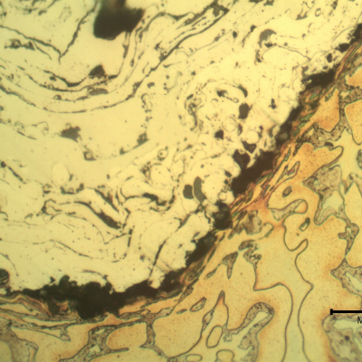 Micrographic detail of the interface between the substrate and the first thermal spray layer.  The substrate (bottom of the figure) shows a ferritic-austenitic microstructure and detrimental phases that look like sigma at the delta and gamma interface. The thermal spray layer (top of the figure) presents the non-etched stainless steel, disposed in layers, with oxides (gray) and voids (black).  The substrate is deformed in a thin layer at the interface.