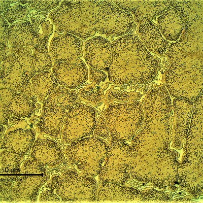 Cast fitting microstructure.  The material presented a network of primary carbided and an austenitic matrix with coalescing secondary precipitation.